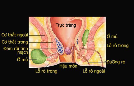 BỆNH TRĨ THEO YHCT