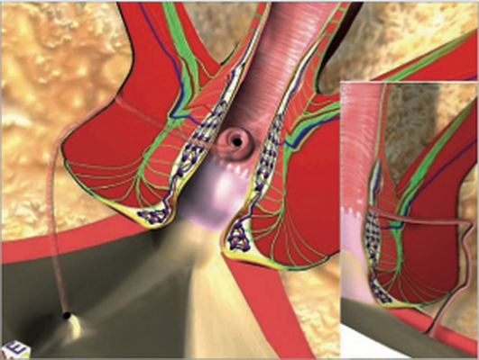 BIẾN CHỨNG NGUY HIỂM CỦA BỆNH TRĨ